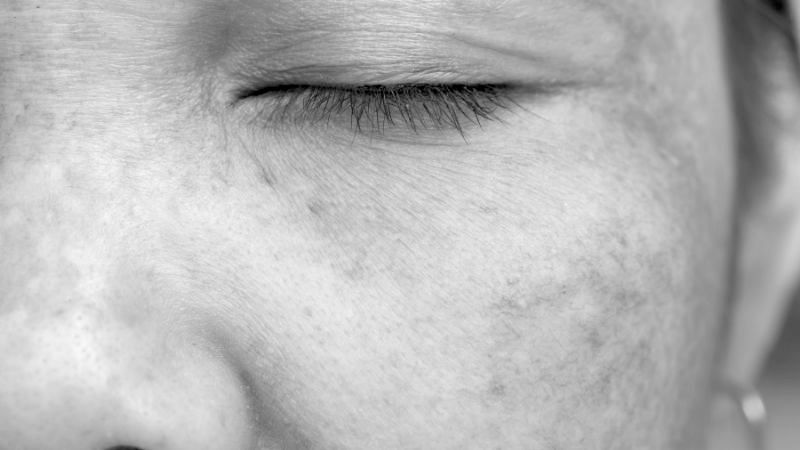 Sun Damaged skin treatment - book an appointment today 