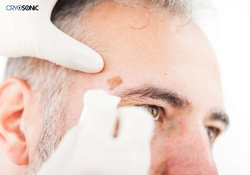 How can I get rid of pimples and dark spots in 2 days? Contact Cryosonic today to find out more! 