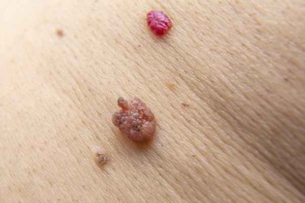 cherry angioma removal  treatment. 