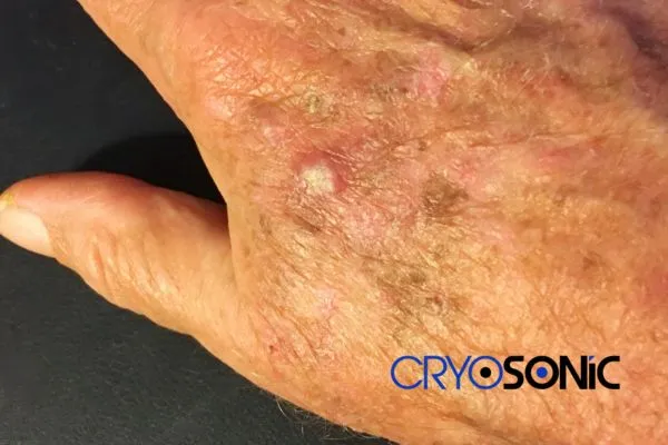 Actinic Keratoses