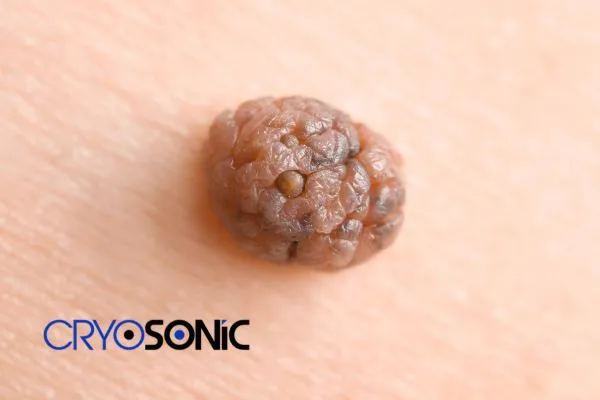 Cryopen the Safest Mole Removal Treatment