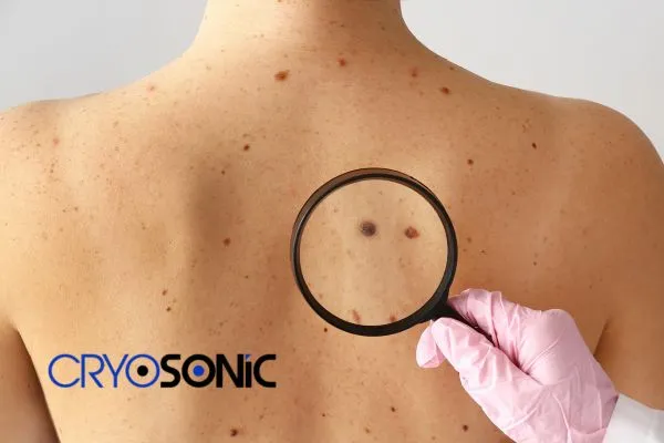 Cryopen the Safest Mole Removal. Book in today!