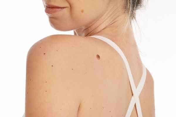 All you need to know about moles removal  treatment - contact Cryosonic today! 