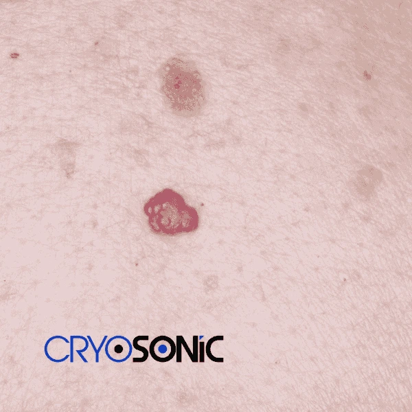 Looking for pain free cherry angioma removal treatment ? Call our team today!