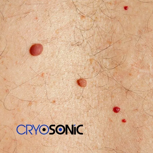 get cherry angioma removal treatment today!