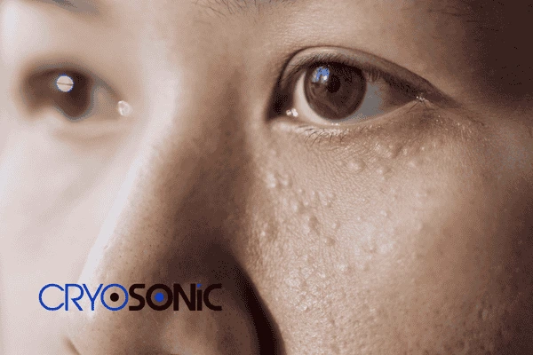 Book in for cryopen treatment today contact our team now! 