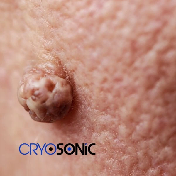 Book your Dermatofibroma removal today 