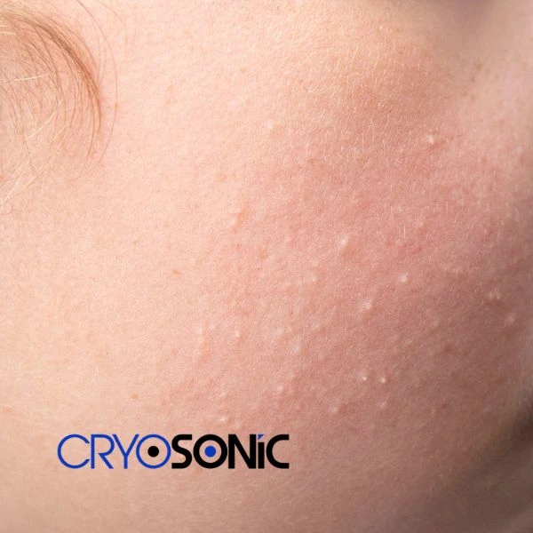 Are you looking for milia removal treatment? Contact our team today