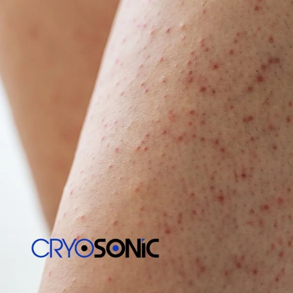 Looking for Seborrhoeic Keratosis removal treatment? Call our consultants today in