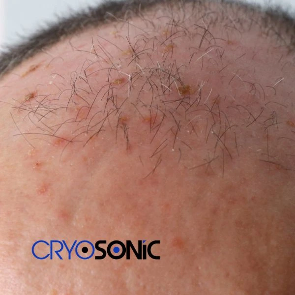 Access Seborrhoeic Keratosis removal from the comfort of your own home! Call us today in