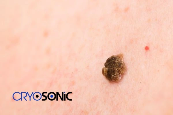 Book your Seborrhoeic Keratosis removal  online today! 