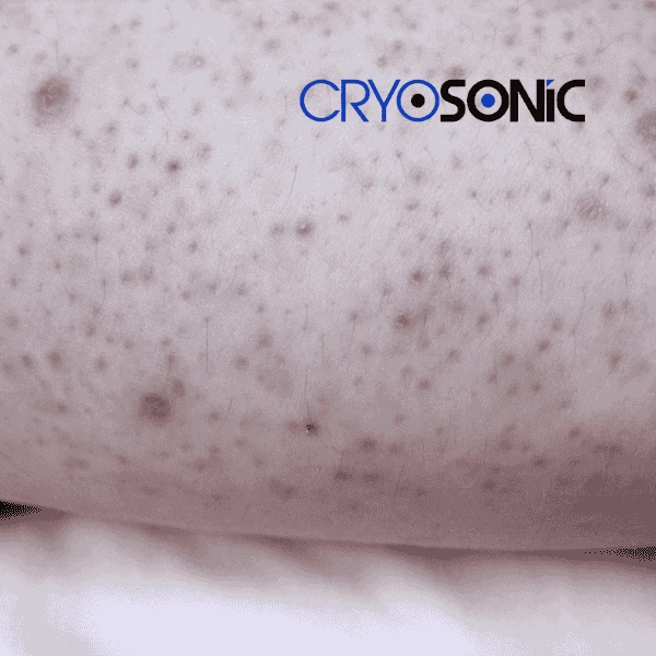 Ready to start actinic keratosis treatment? Contact our team today 