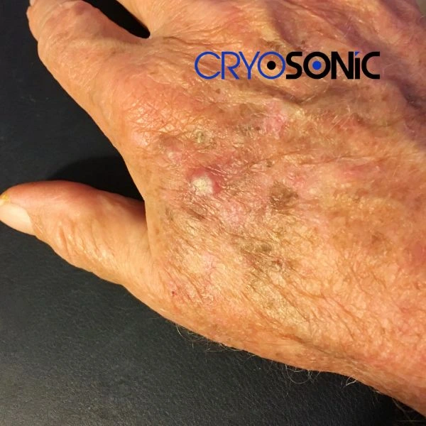 Understand more about actinic keratosis treatment today 
