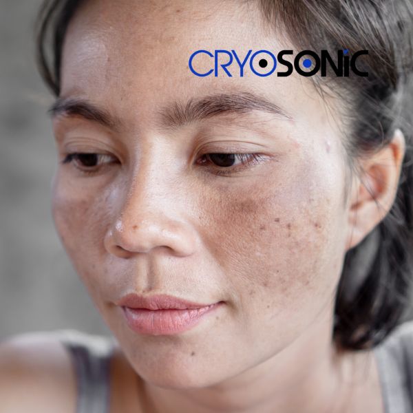 Ready to start age spots removal? Contact our team today in