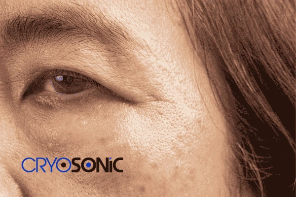 Start age spots removal  treatment today! Call our team now! 