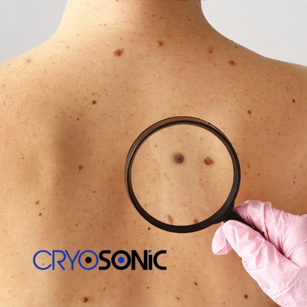 Cryopen treatment - fast effect blemish removal book in now 