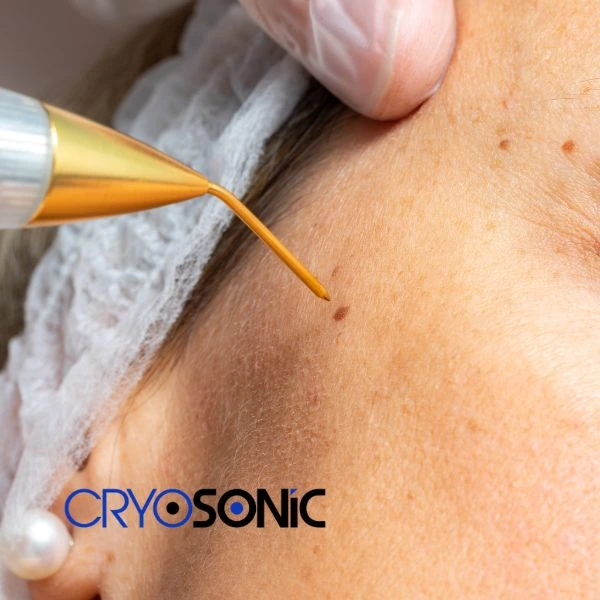 interested in cryopen treatment? Contact our team today!