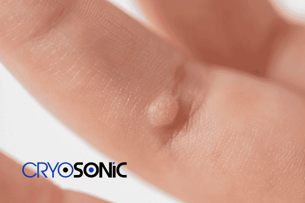 Cryopen treatment here to help all you live blemish free - book a consultation today! 