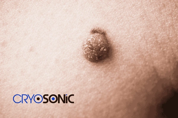 Looking for non surgical Dermatofibroma removal ? Contact us today 