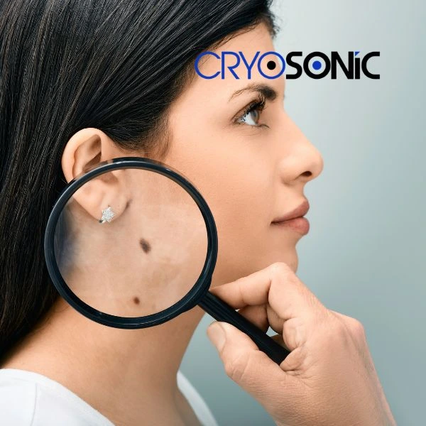 Do you want to learn more about benign moles removal treatment? Call our team today