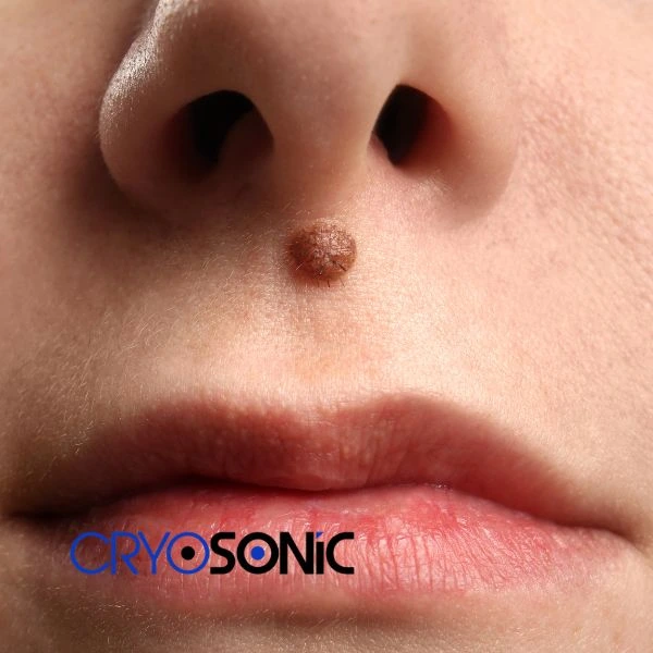 Start your benign moles removal treatment today
