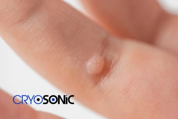 Contact Cryosonic today to learn more about us  now! 