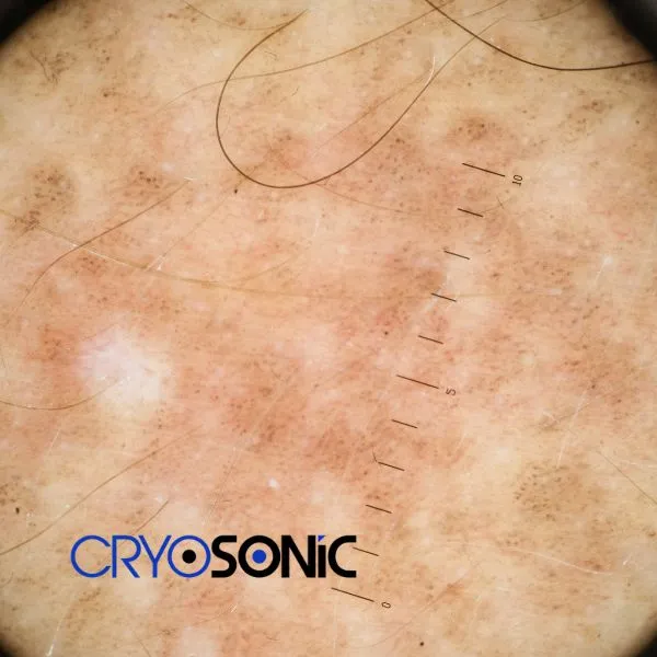 Speak to our team today about sun damaged skin treatment today in 