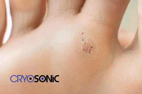 Book in your Verrucae removal treatment today  