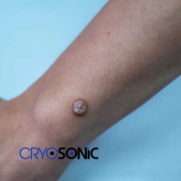 Deep Verrucae removal treatment possible from your own home! Book treatment today 