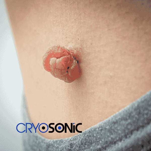 Book your skin tags removal from comfort of your own home!