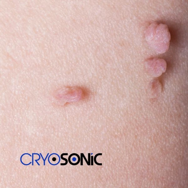 Are you looking for fast effect skin tag removal ? Book in NOW!
