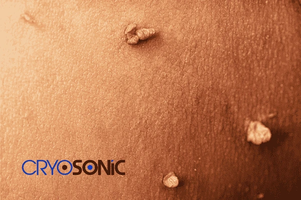 Do you want to get skin tags removal ? Contact our team today! 