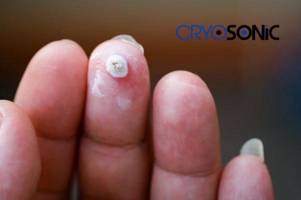 Local and fast warts removal. Contact our team today! 