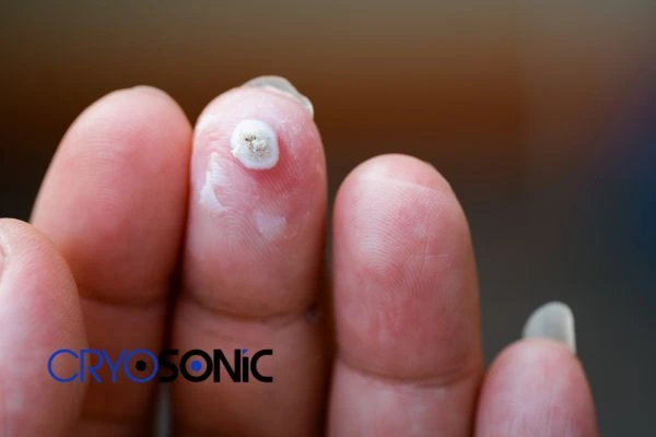 Can you cut warts off with nail clippers? What are the risks? Find out now!
