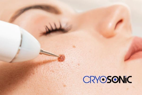 why choose us at Cryosonic for blemish removal? Find out more now 
