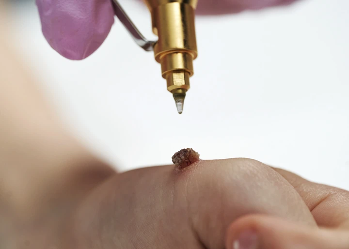 Cryopen For Children Bristol 
