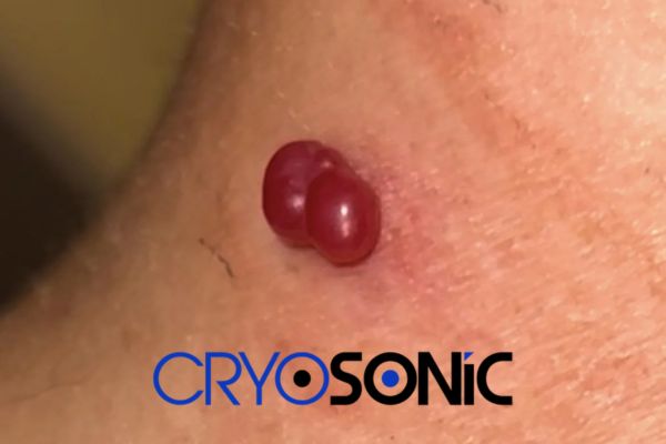 Large two-headed Cherry Angioma