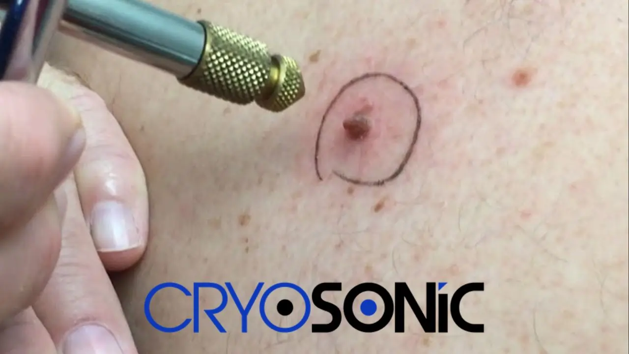 What potential negative effects could CryoPen therapy have? 
