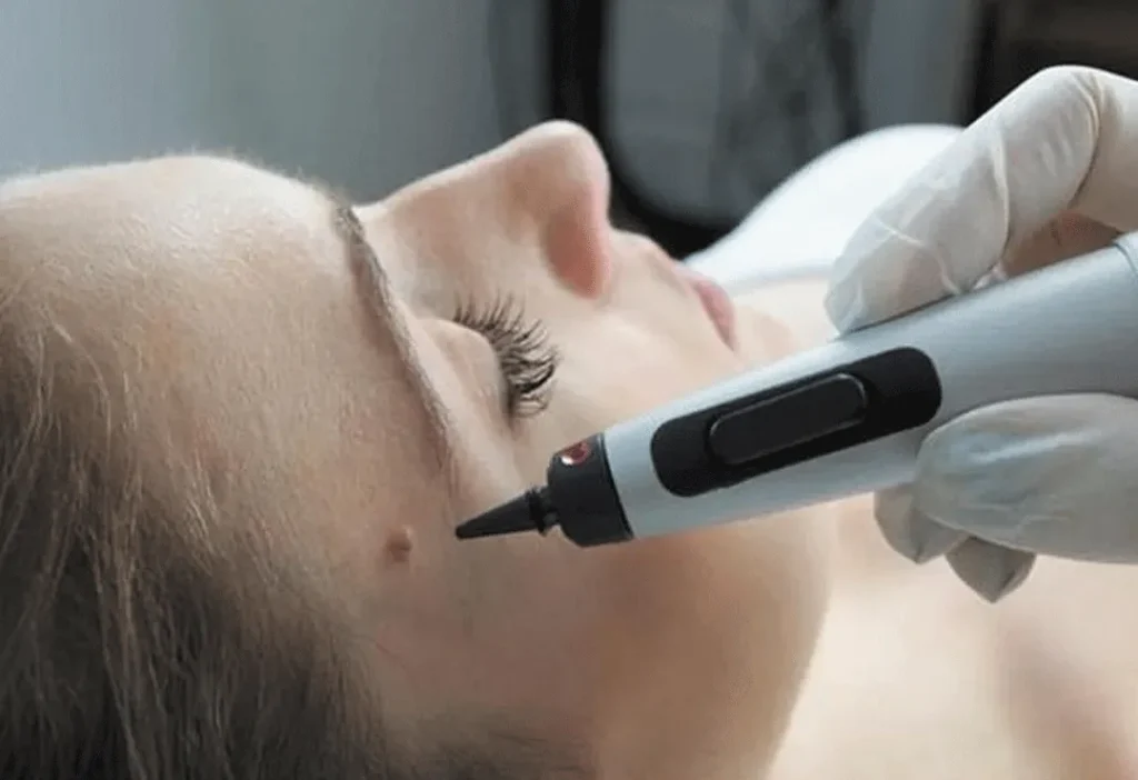CryoPen accurately targeting skin lesions with millimetre-precision for safe and effective removal by Cryosonic 