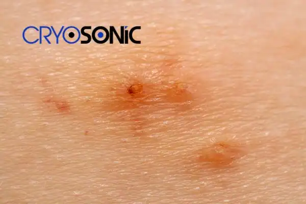 Image of Molluscum Contagiosum Treatment  