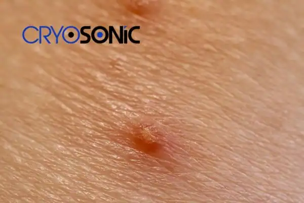 Molluscum Contagiosum Treatment  