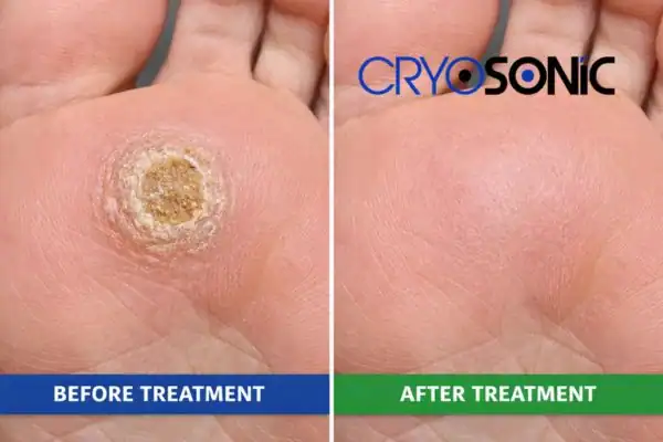 Before and after results of Porokeratosis Treatment  